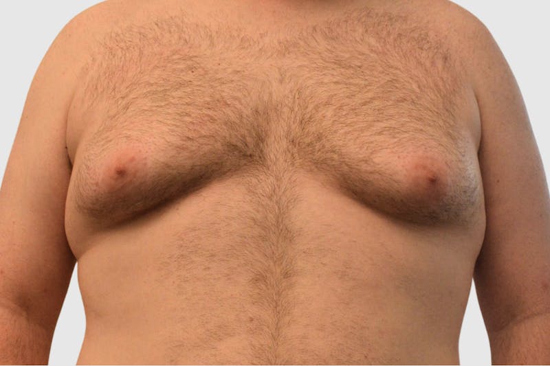 Gynecomastia Before & After Gallery - Patient 101416 - Image 1