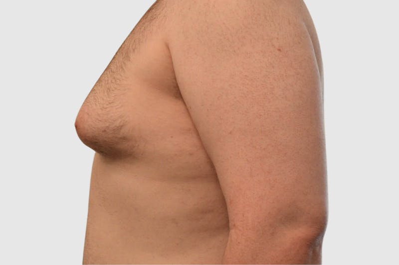 Gynecomastia Before & After Gallery - Patient 101416 - Image 3