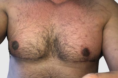 Gynecomastia Before & After Gallery - Patient 189378 - Image 1