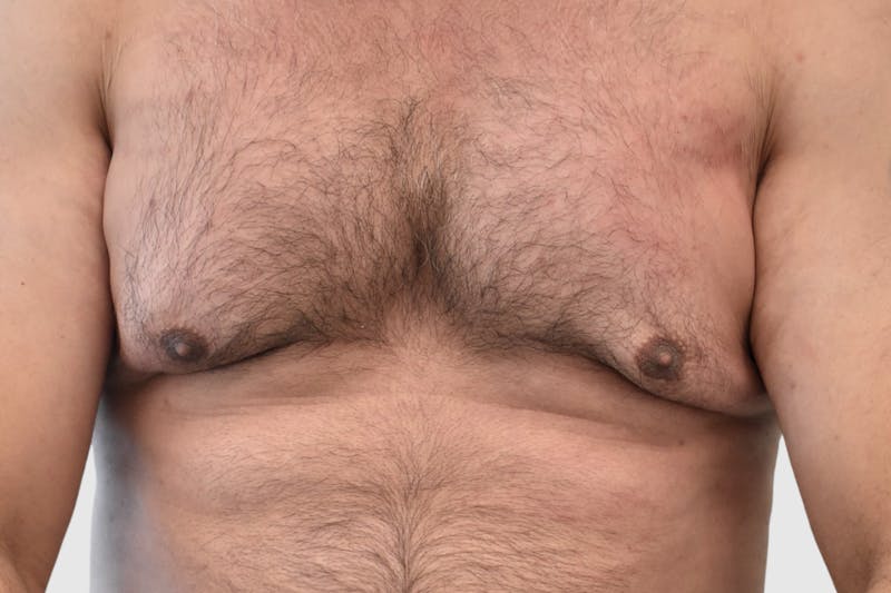 Gynecomastia Before & After Gallery - Patient 189378 - Image 2