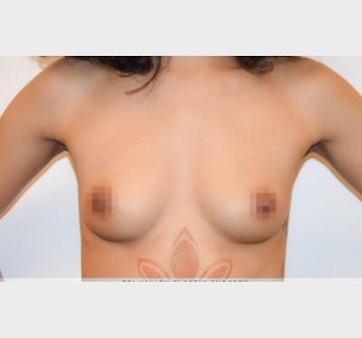 Breast Augmentation Before & After Gallery - Patient 191674785 - Image 1