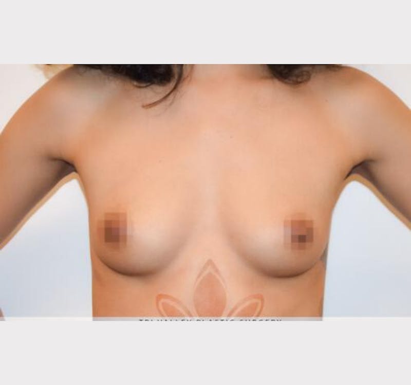 Breast Augmentation Before & After Gallery - Patient 191674785 - Image 1