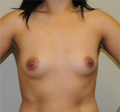 Breast Augmentation Before & After Gallery - Patient 191674666 - Image 1