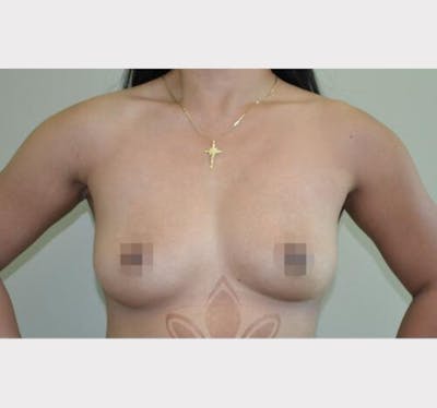 Breast Augmentation Before & After Gallery - Patient 191674788 - Image 1