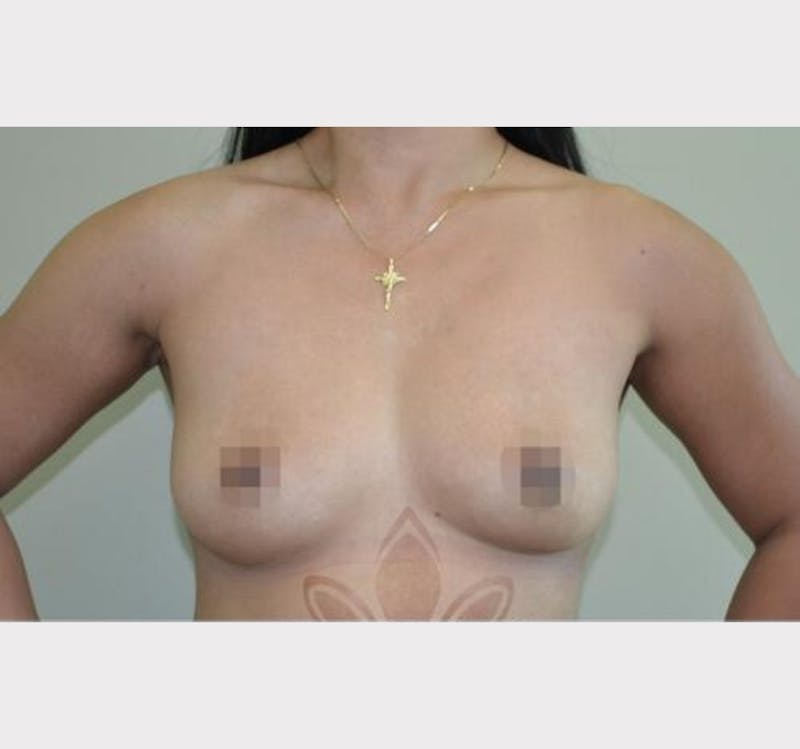 Breast Augmentation Before & After Gallery - Patient 191674788 - Image 1