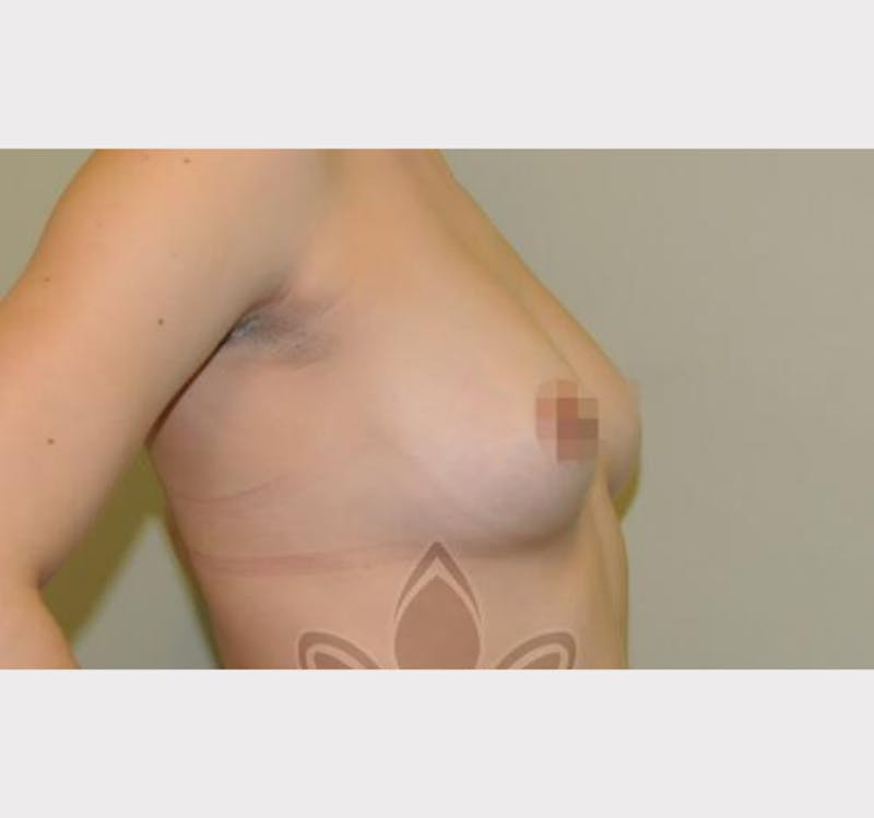 Breast Augmentation Before & After Gallery - Patient 191674789 - Image 3