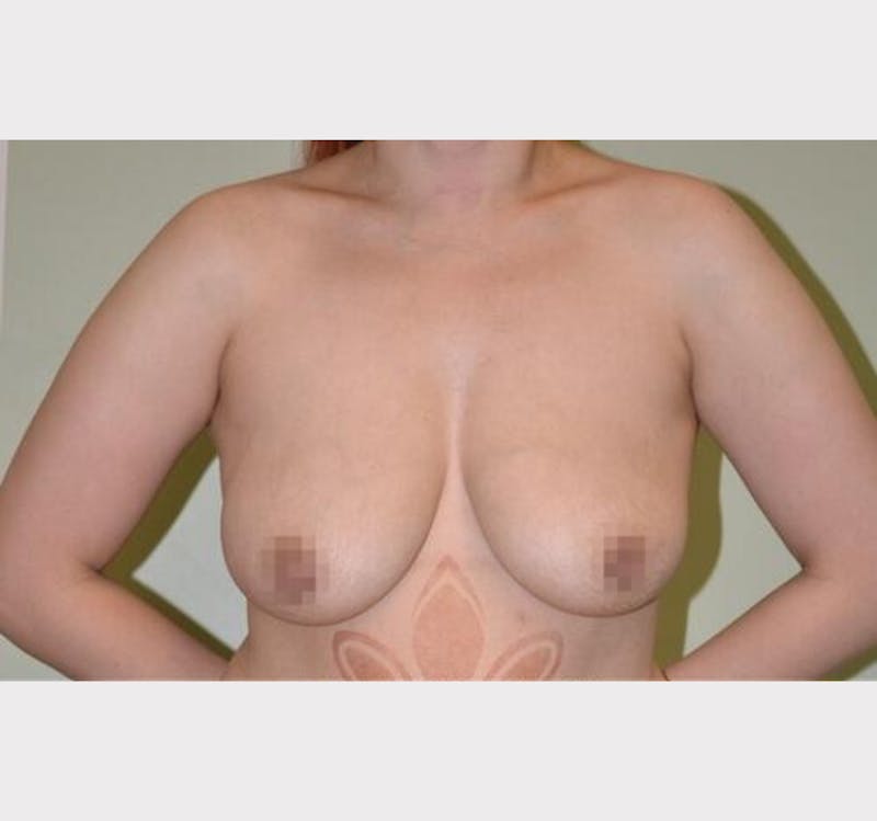Breast Augmentation Before & After Gallery - Patient 191404786 - Image 1