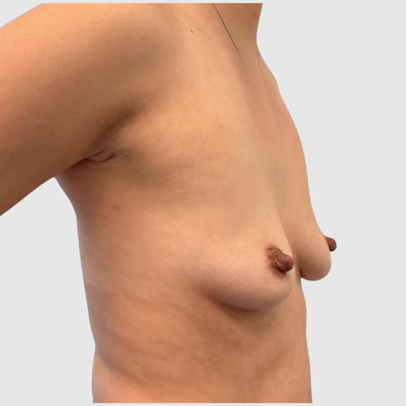Breast Augmentation Before & After Gallery - Patient 821458 - Image 1