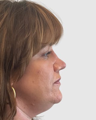 Rhinoplasty Before & After Gallery - Patient 222207 - Image 2