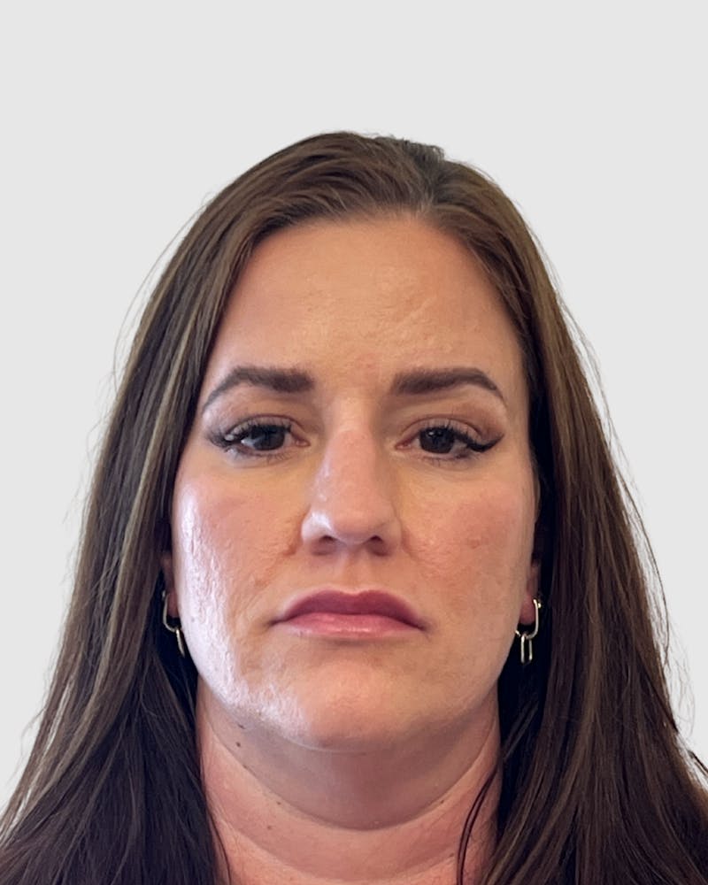 Rhinoplasty Before & After Gallery - Patient 222207 - Image 3