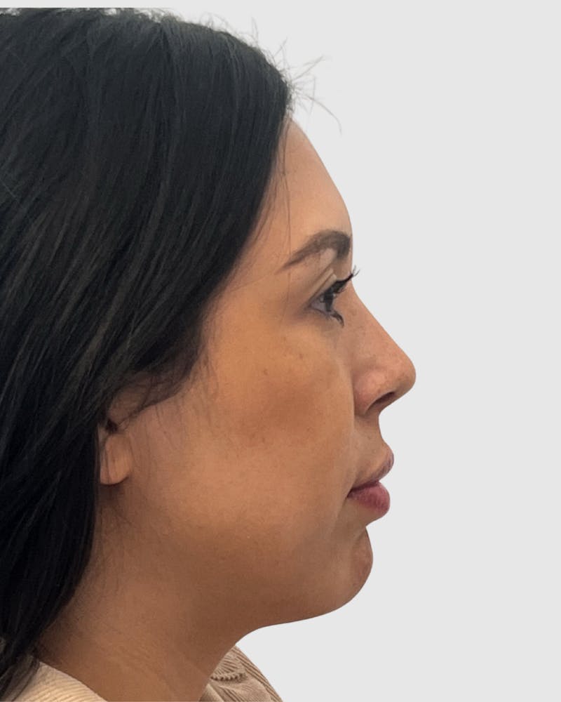 Rhinoplasty Before & After Gallery - Patient 141222 - Image 2