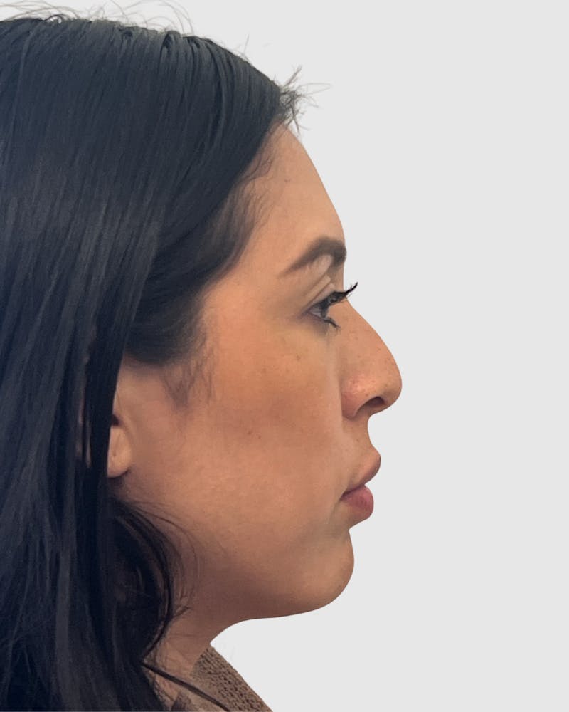 Rhinoplasty Before & After Gallery - Patient 141222 - Image 1