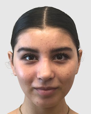 Rhinoplasty Before & After Gallery - Patient 268724 - Image 4