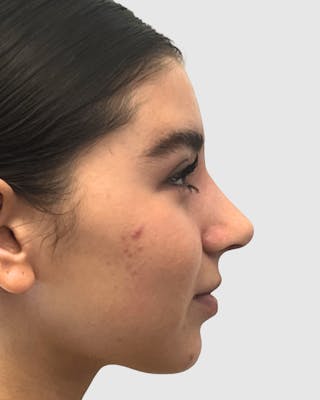 Rhinoplasty Before & After Gallery - Patient 268724 - Image 2