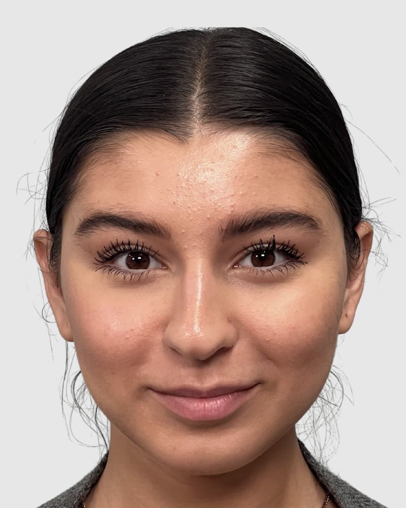 Rhinoplasty Before & After Gallery - Patient 268724 - Image 3