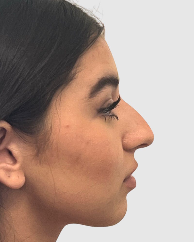 Rhinoplasty Before & After Gallery - Patient 268724 - Image 1