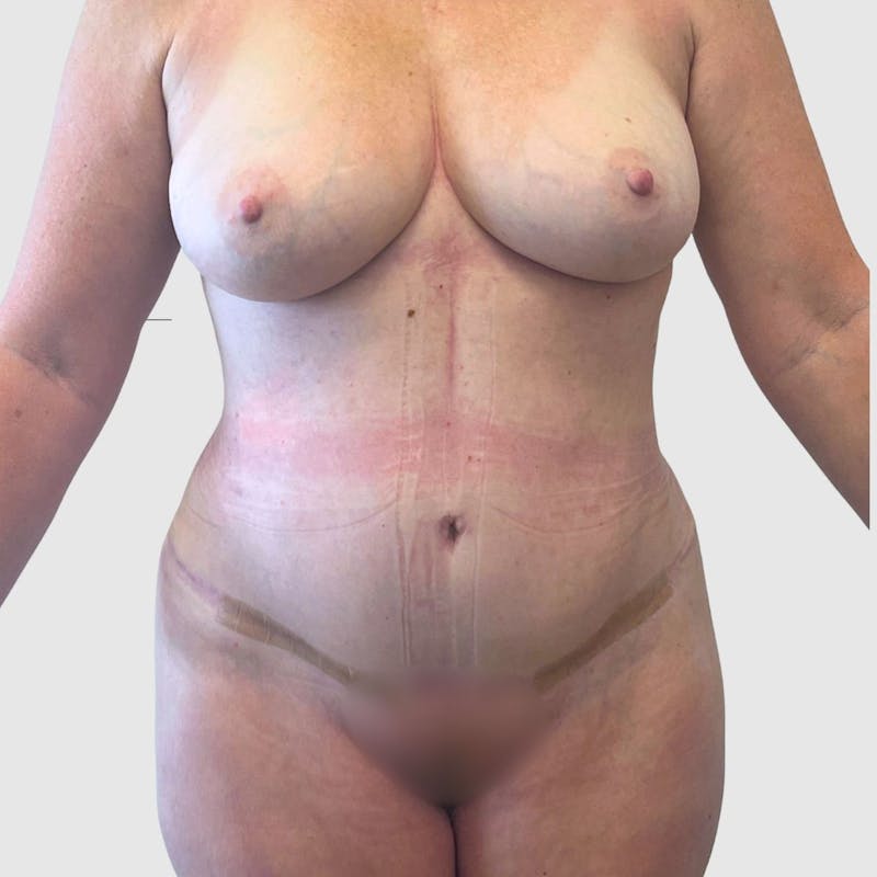Tummy Tuck Before & After Gallery - Patient 363842 - Image 2