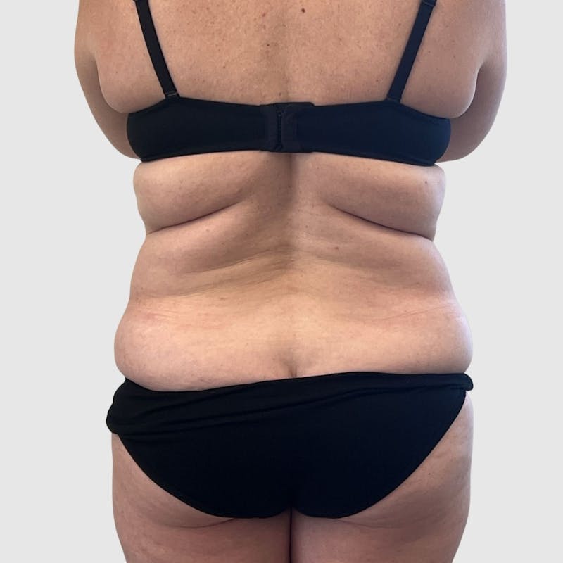 Tummy Tuck Before & After Gallery - Patient 363842 - Image 3