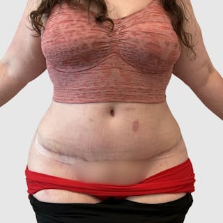Tummy Tuck Before & After Gallery - Patient 239345 - Image 2