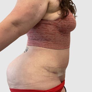 Tummy Tuck Before & After Gallery - Patient 239345 - Image 4
