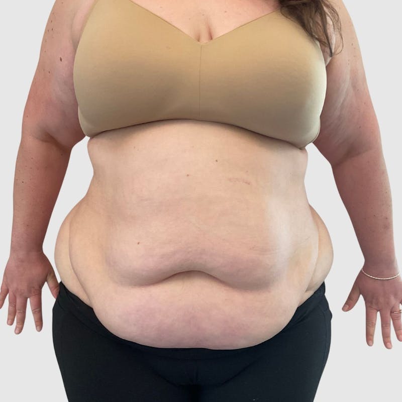 Tummy Tuck Before & After Gallery - Patient 239345 - Image 1