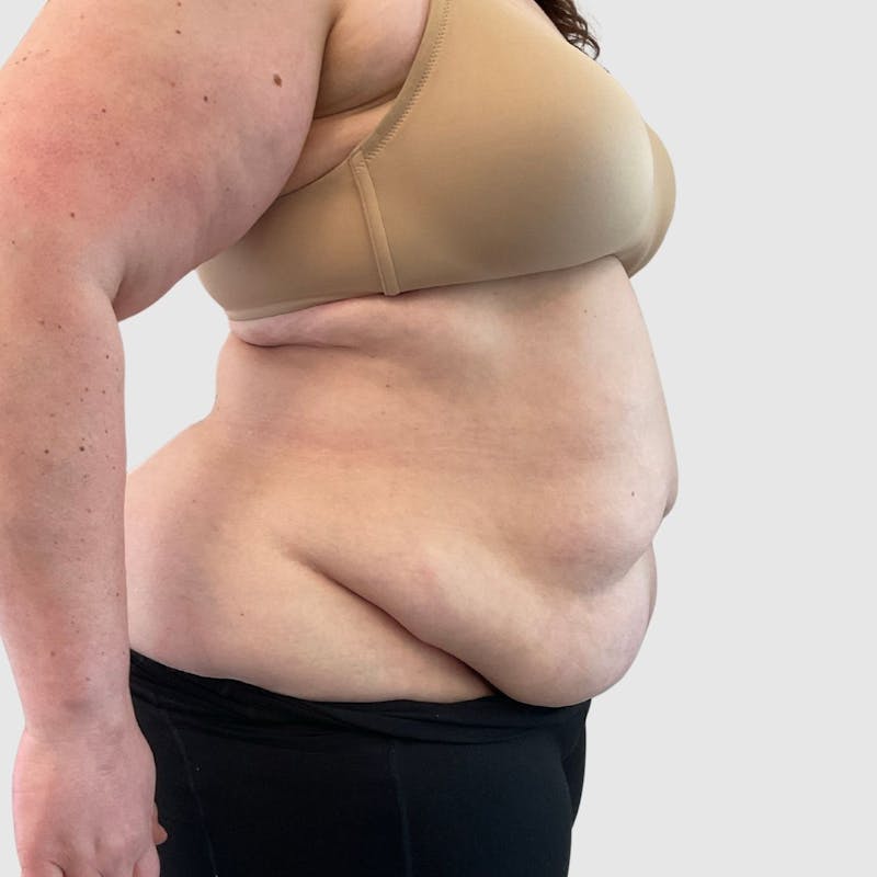 Tummy Tuck Before & After Gallery - Patient 239345 - Image 3