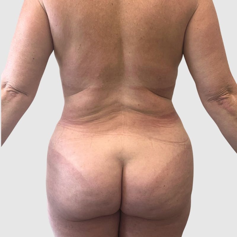 Tummy Tuck Before & After Gallery - Patient 363842 - Image 4