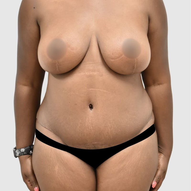 Tummy Tuck Before & After Gallery - Patient 277307 - Image 2
