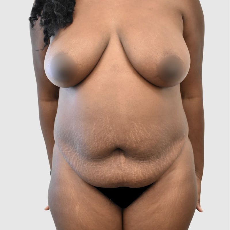 Tummy Tuck Before & After Gallery - Patient 277307 - Image 1