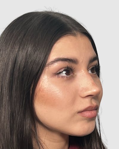 Rhinoplasty Before & After Gallery - Patient 268724 - Image 2
