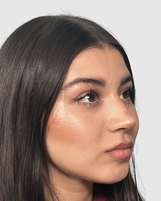 Rhinoplasty Before & After Gallery - Patient 268724 - Image 2