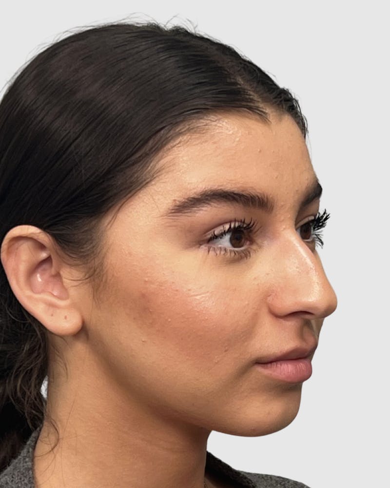 Rhinoplasty Before & After Gallery - Patient 268724 - Image 1
