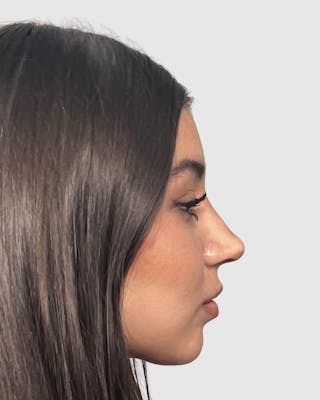 Rhinoplasty Before & After Gallery - Patient 268724 - Image 4