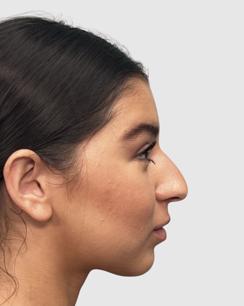 Rhinoplasty Before & After Gallery - Patient 268724 - Image 3