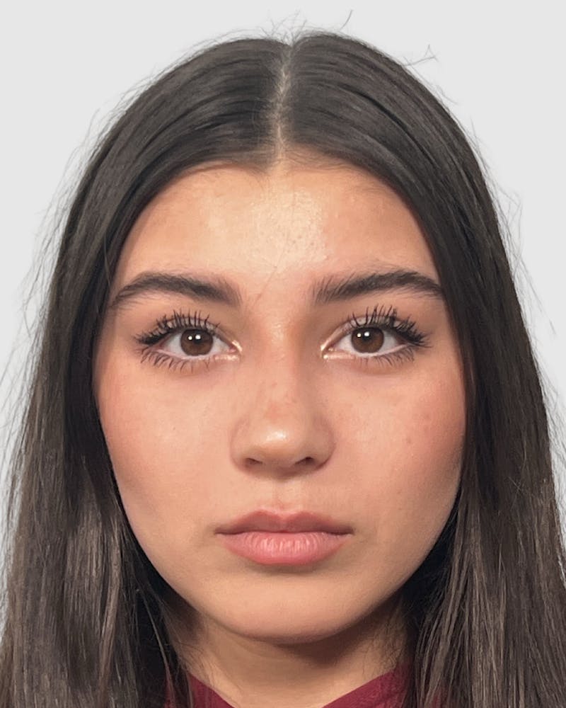 Rhinoplasty Before & After Gallery - Patient 268724 - Image 6