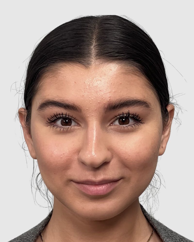Rhinoplasty Before & After Gallery - Patient 268724 - Image 5
