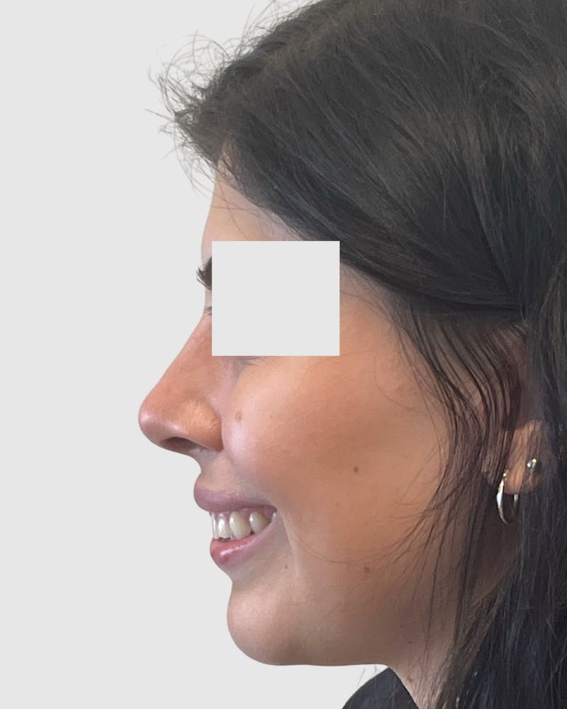 Rhinoplasty Before & After Gallery - Patient 315735 - Image 2