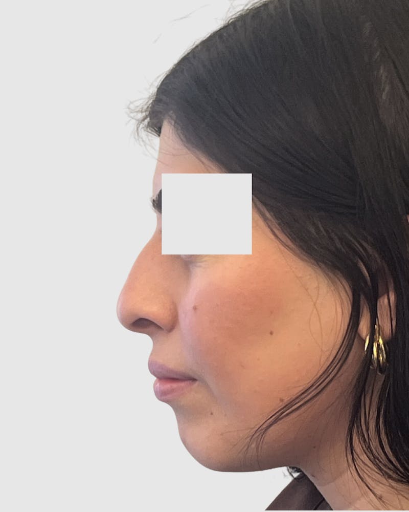 Rhinoplasty Before & After Gallery - Patient 315735 - Image 1