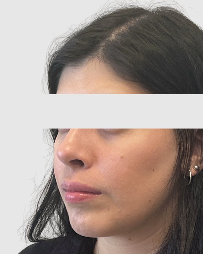 Rhinoplasty Before & After Gallery - Patient 315735 - Image 4