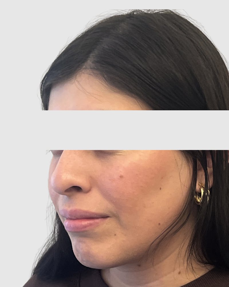 Rhinoplasty Before & After Gallery - Patient 315735 - Image 3