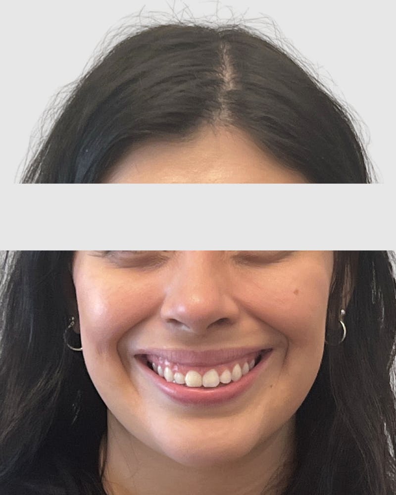 Rhinoplasty Before & After Gallery - Patient 315735 - Image 6