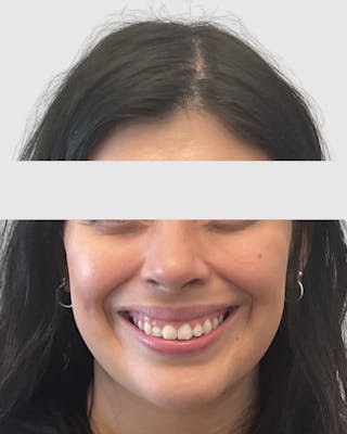 Rhinoplasty Before & After Gallery - Patient 315735 - Image 6