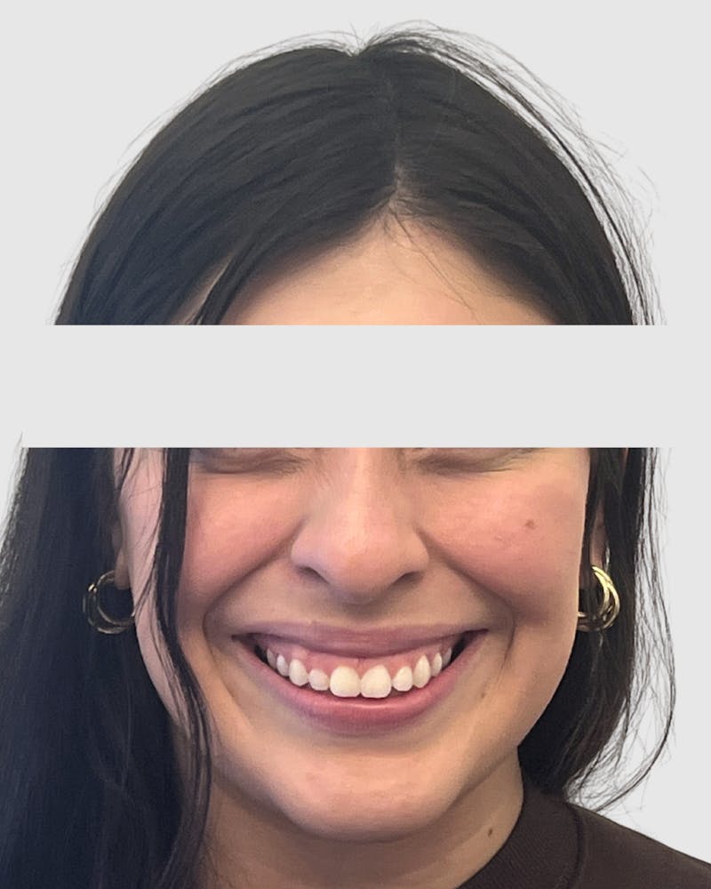Rhinoplasty Before & After Gallery - Patient 315735 - Image 5