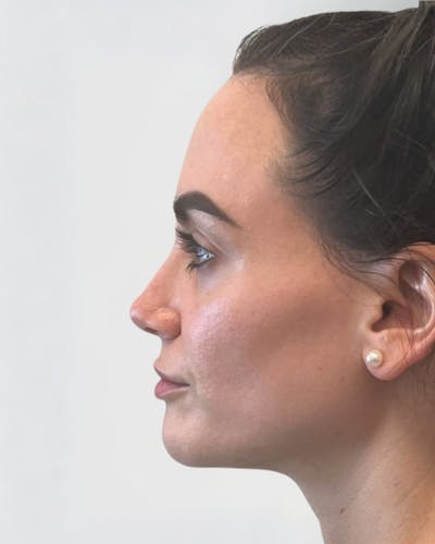 Rhinoplasty Before & After Gallery - Patient 427624 - Image 2