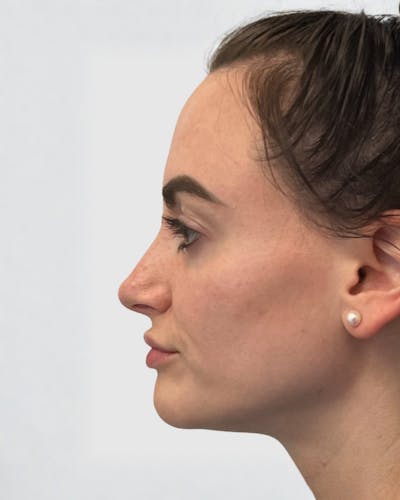 Rhinoplasty Before & After Gallery - Patient 427624 - Image 1
