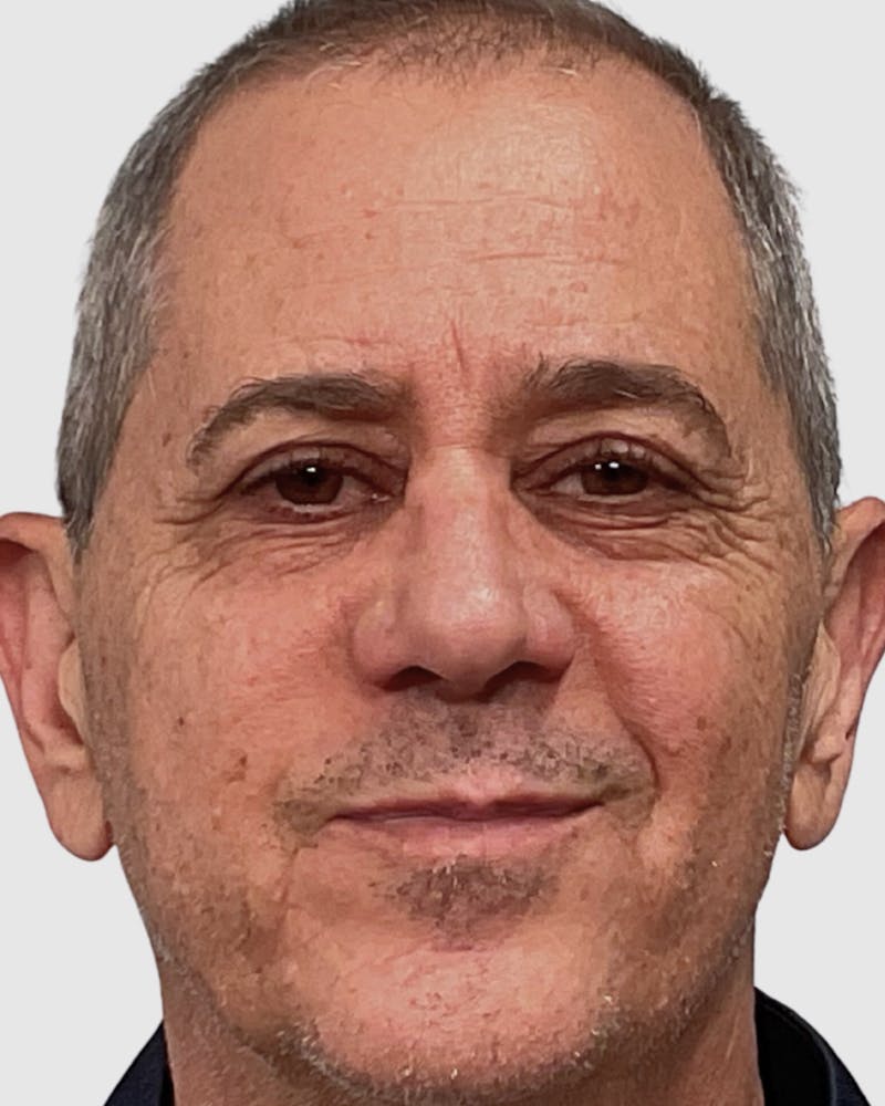 Blepharoplasty Before & After Gallery - Patient 364402 - Image 1