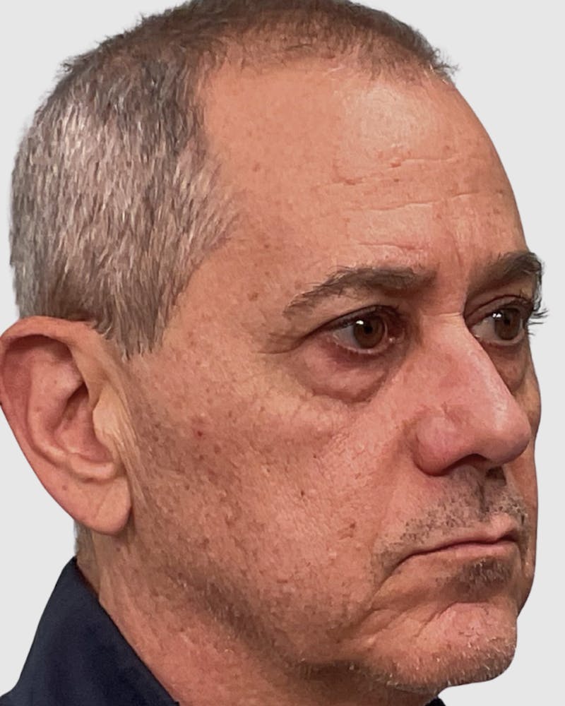 Blepharoplasty Before & After Gallery - Patient 364402 - Image 3