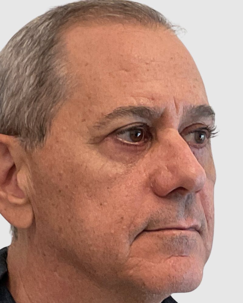 Blepharoplasty Before & After Gallery - Patient 364402 - Image 4