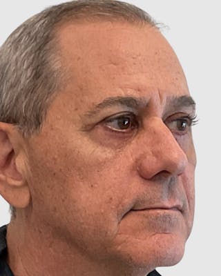 Blepharoplasty Before & After Gallery - Patient 364402 - Image 4