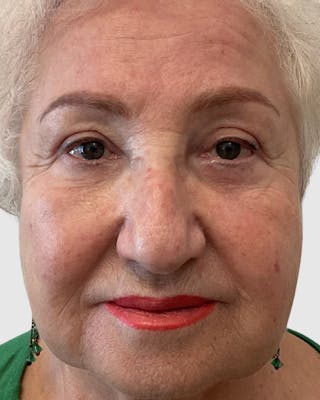 Blepharoplasty Before & After Gallery - Patient 272583 - Image 2